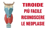 Tiroide, da oggi più facile riconoscere le neoplasie