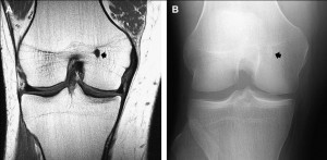 legamento ginocchio risonanza magnetica articolare