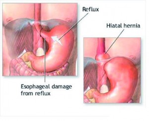 reflusso gastroesofageo reflusso gastro-esofageo