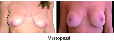 mastopessi chirurgia plastica del seno
