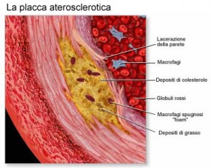 ictus cardiopatia ischemica placca aterosclerotica