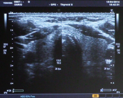 ecografia della tiroide ecografia tiroidea