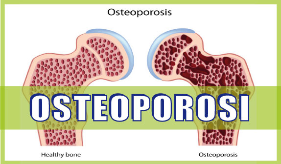 Osteoporosi: fattori di rischio e prevenzione