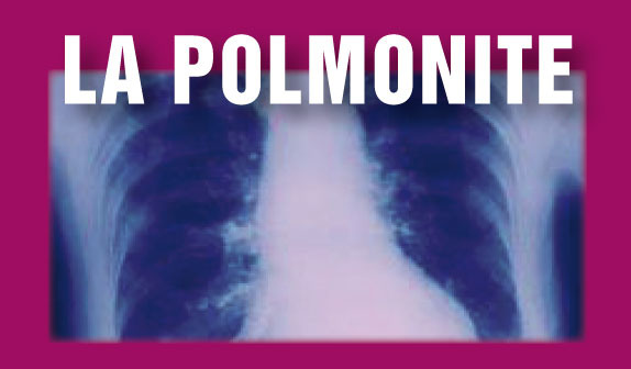 Polmonite – Cause, Diagnosi e Terapia
