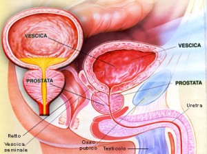 prostata tumore ipertrofia prostatica benigna