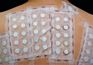 patch test allergia al nichel