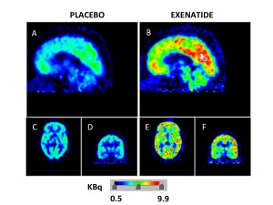 exenatide metabolismo cervello