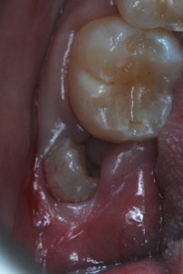 dente del giudizio incluso disodontiasi