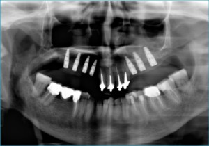 impianti dentali protesi dentali implantologia dentale edentulia ortopanoramica dentale