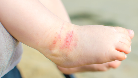dermatite atopica itchy dermatitis