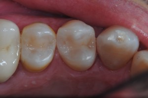 intarsi dentali ricostruzione denti