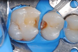 intarsi dentali diga di gomma ricostruzione denti